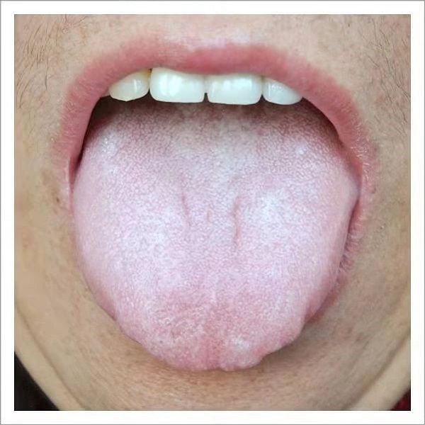 舌质淡苔白腻图片